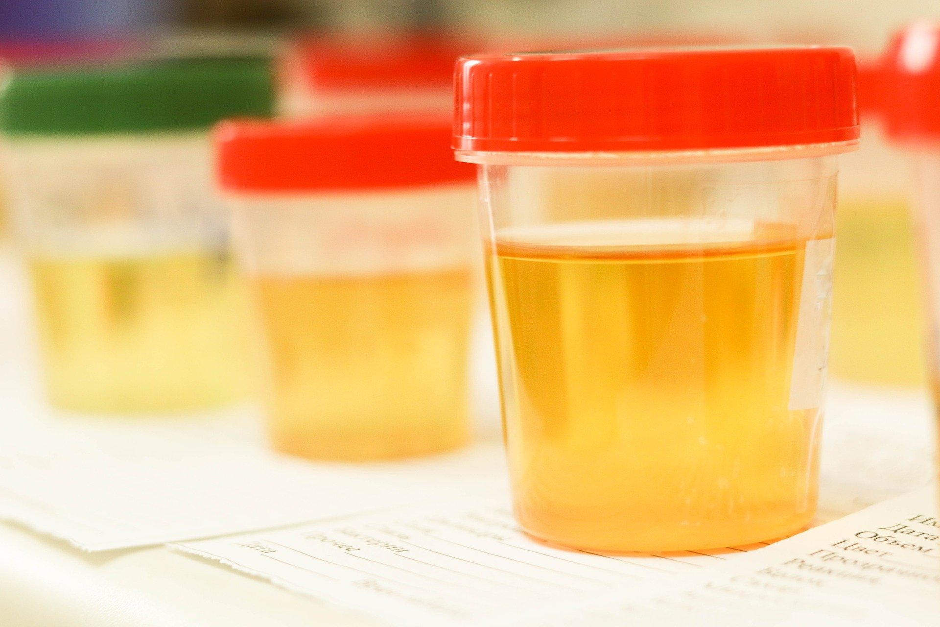 Types of Urine Tests